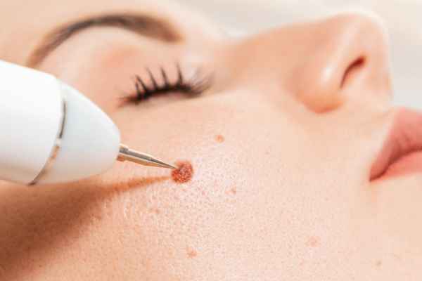 CryoPen: 5 Skin Concerns It May Be Used to Treat 3 What actually happens during a CryoPen treatment Derbyshire?