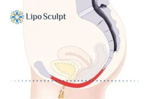 Pelvic Floor Chair Therapy 1 Pelvic Floor Chair Therapy Derbyshire to treat incontinence.