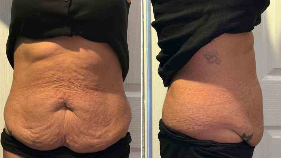 Lost the Weight but Not the Loose Skin? What You Should Know 1 Is It Definitely Loose Skin Derbyshire?